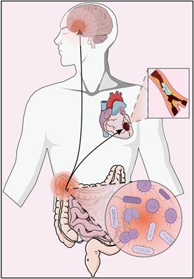 Gut microbiome metabolites as key actors in atherosclerosis co-depression disease